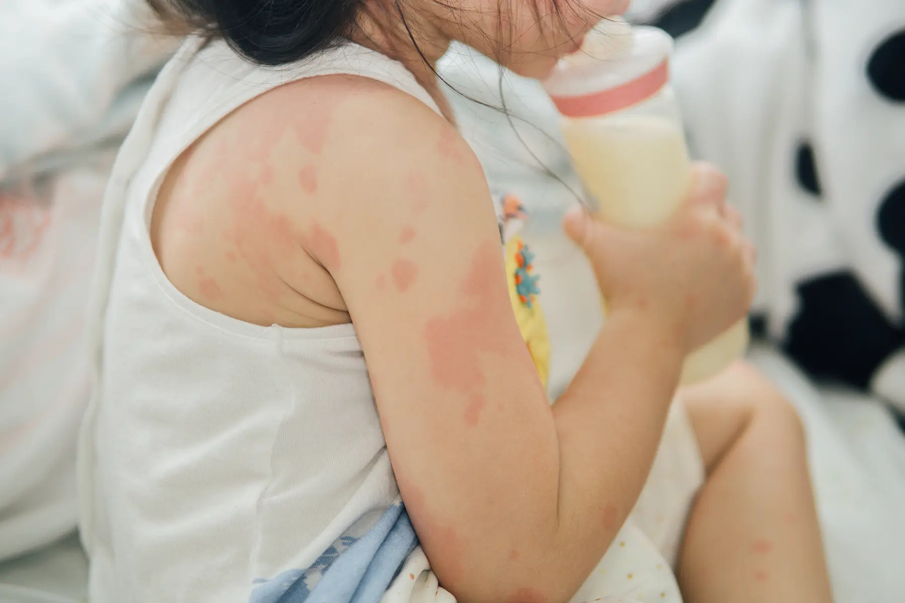Nhận biết dấu hiệu trẻ bị dị ứng sữa công thức và hướng xử lý