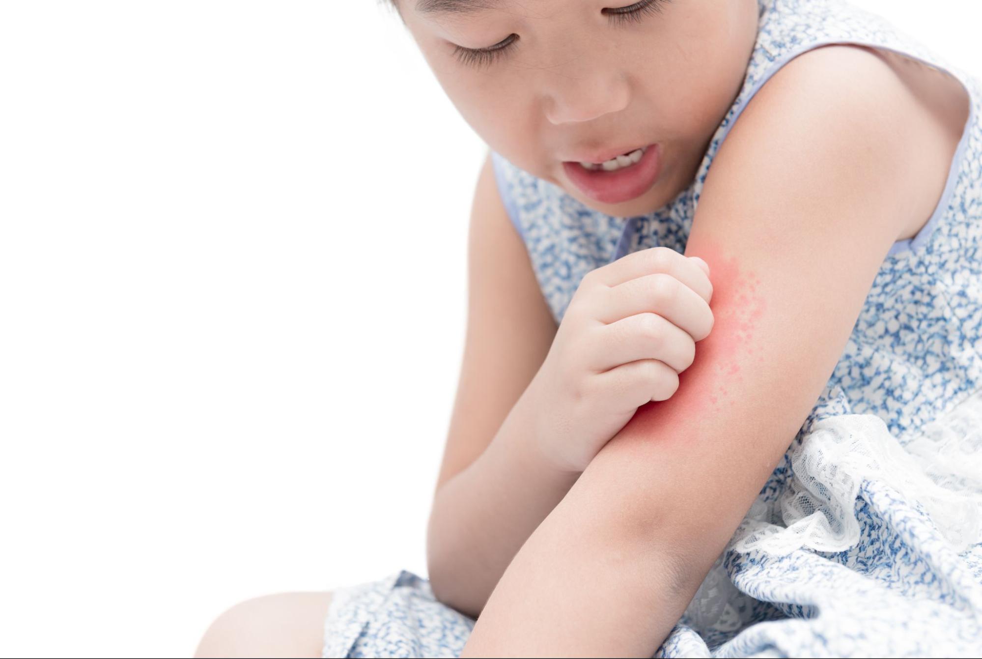 Bé bị ngứa ngáy sau khi uống sữa là dấu hiệu gợi ý trẻ bị dị ứng với sữa công thức Bé bị ngứa ngáy sau khi uống sữa là dấu hiệu gợi ý trẻ bị dị ứng với sữa công thức
